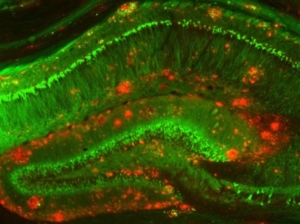 In a person with Alzheimer's, harmful amyloid beta clusters (red) build up among neurons (green) in a memory-related area of the brain. (Photo/Strittmatter Laboratory, Yale University)